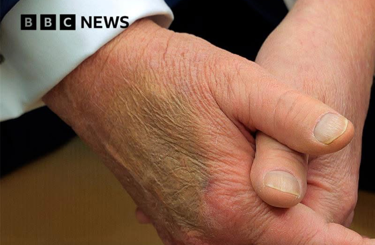 United States(US) President Donald Trump suffering from chronic blood circulation failure disease, White House confirms.